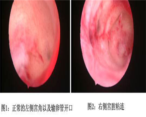 供卵包怀男孩：孕晚期可以用马应龙痔疮膏吗